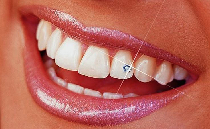 پیرسینگ دندان