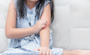 psoriasis-in-kids