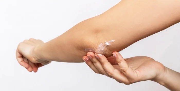urea-cream-for-elbow-peeling